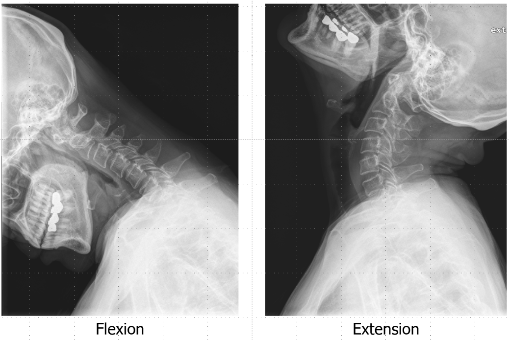 단순 X선 촬영 (Plain radiography)