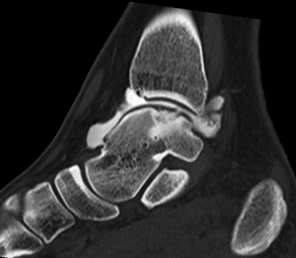 관절조영술 (Arthrography)