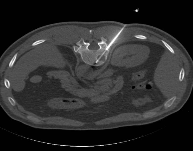 조직 생검 (Biopsy) 및 흡인