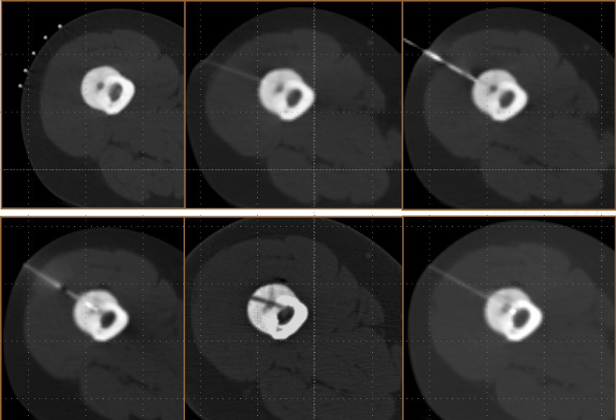 고주파 소작술 (RFA, Radiofrequency ablation)