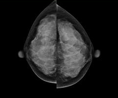 유방촬영술 (Mammography)
