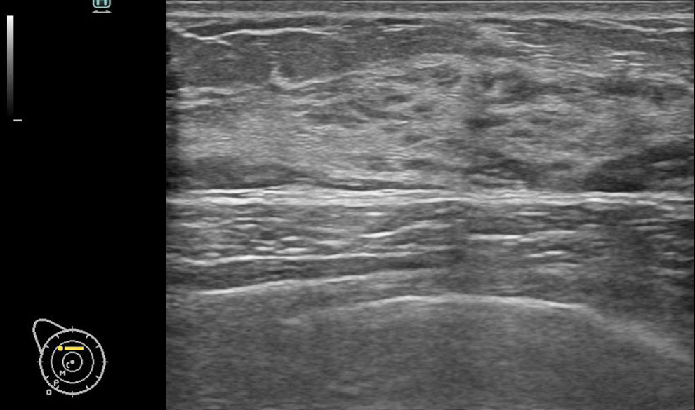유방초음파 (Ultrasound)