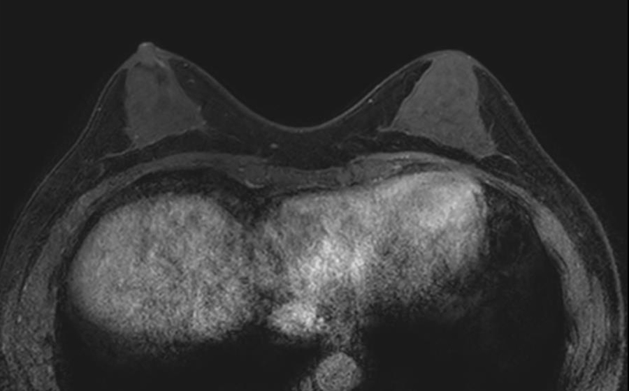 자기공명영상 (MRI)