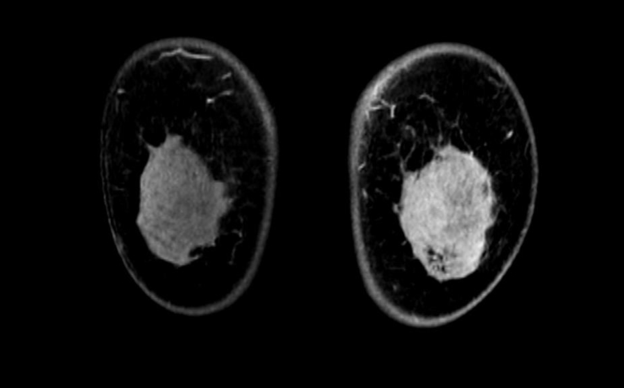 자기공명영상 (MRI)