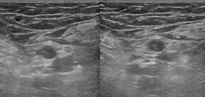 초음파 검사 (Ultrasonography)