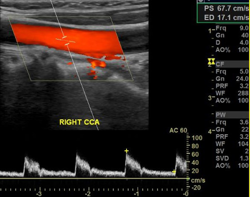 초음파 검사 (Ultrasonography)