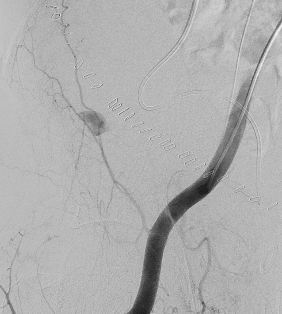 진단적 혈관조영술 (Diagnostic Angiography)