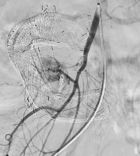 진단적 혈관조영술 (Diagnostic Angiography)