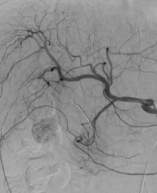 경동맥화학 색전술 (TACE : TransArterial ChemoEmbolization)