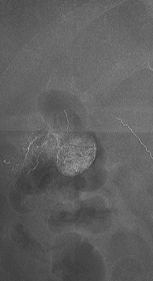 경동맥화학 색전술 (TACE : TransArterial ChemoEmbolization)