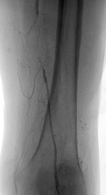 말초혈관질환 (Pheripheral arterial disease)