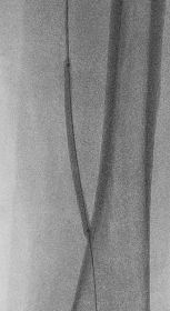 말초혈관질환 (Pheripheral arterial disease)