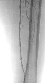 말초혈관질환 (Pheripheral arterial disease)