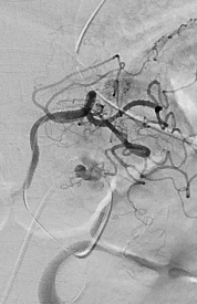 출혈환자 색전술 (Bleeding Embolization)