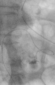 출혈환자 색전술 (Bleeding Embolization)