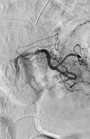 출혈환자 색전술 (Bleeding Embolization)