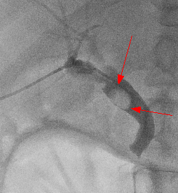 담도계 인터벤션 (Biliary Intervention)