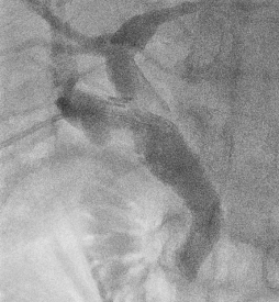 담도계 인터벤션 (Biliary Intervention)