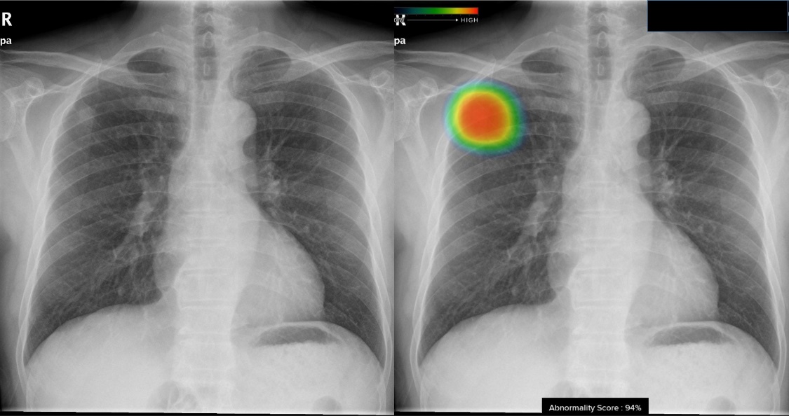 흉부 단순촬영 (Chest radiography)
