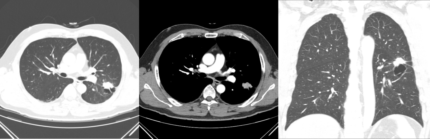 컴퓨터단층촬영 (CT, computed tomography)