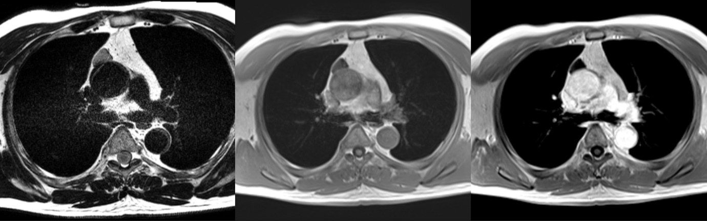 자기공명영상 (MRI, magnetic resonance image)
