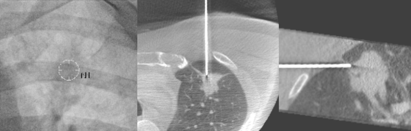 영상 유도 하 조직 생검 (Image-guided biopsy)