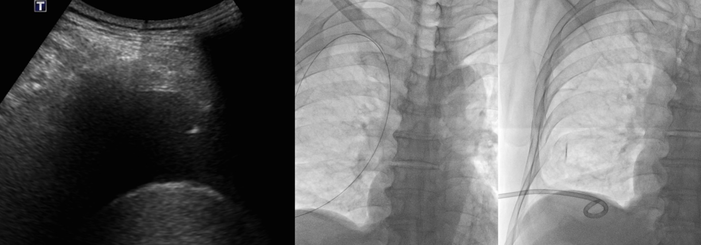 영상 유도 하 경피적 흡인술/배액술 (Image-guided percutaneous aspiration/drainage)