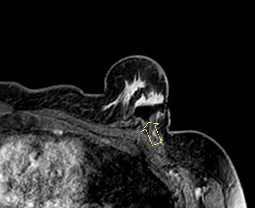MRI 유방 진공흡인 조직검사