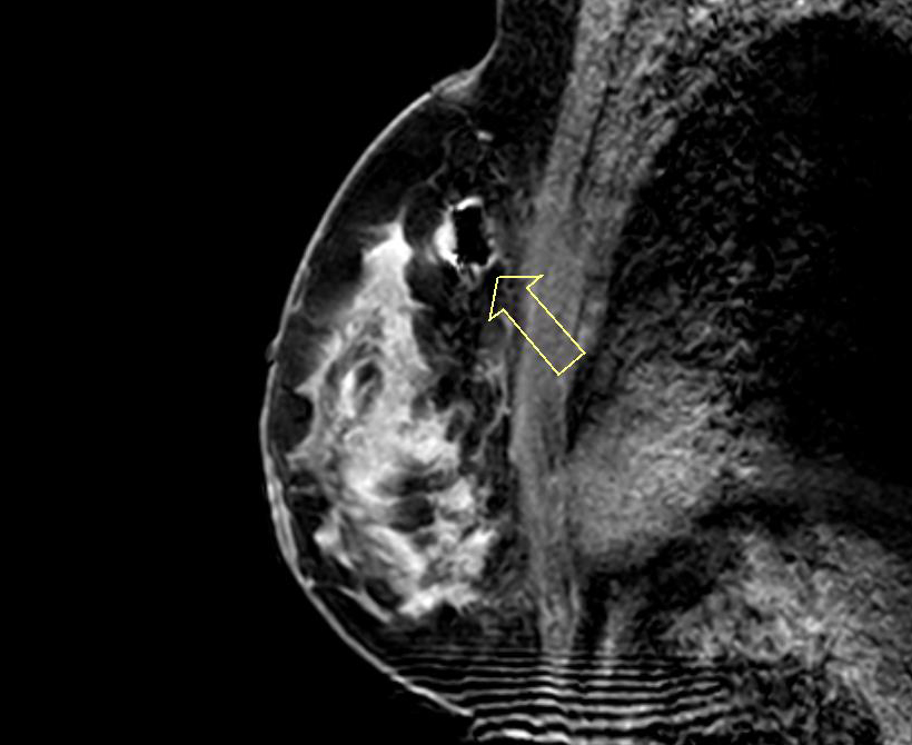 MRI 유방 진공흡인 조직검사