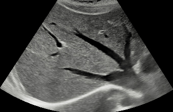 초음파 검사 (Ultrasonography)