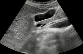 초음파 검사 (Ultrasonography)