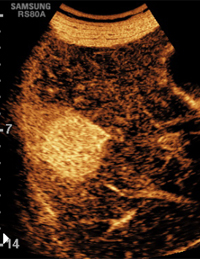 초음파 검사 (Ultrasonography)