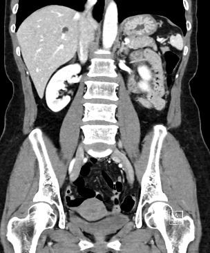 컴퓨터단층촬영 (CT, computed tomography)