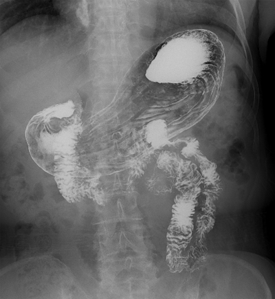 위장관 조영술 (GI Fluoroscopy)