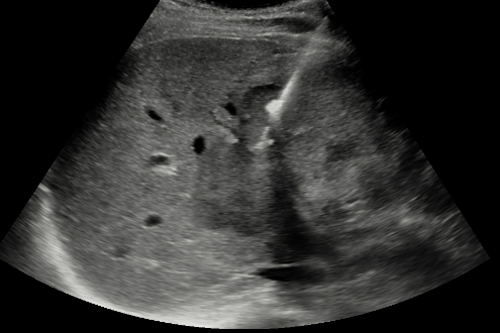 조직 생검 (Biopsy)