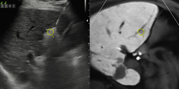 고주파 소작술 (RFA, Radiofrequency ablation)