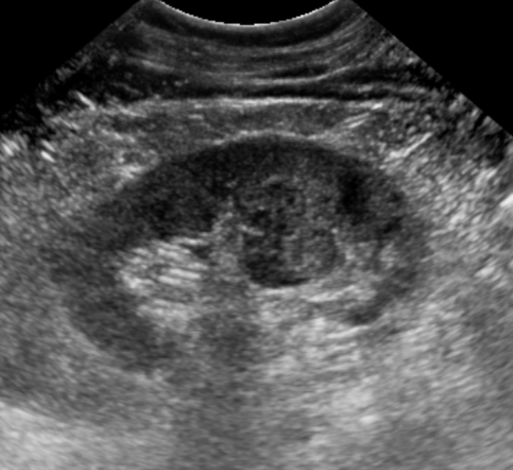 초음파 검사 (Ultrasonography)