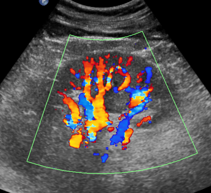 초음파 검사 (Ultrasonography)