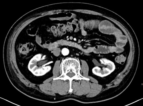 컴퓨터 단층촬영 (Computed tomography, CT)