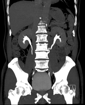 컴퓨터 단층촬영 (Computed tomography, CT)