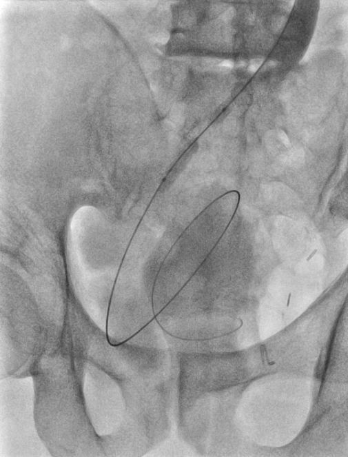 비뇨기계 중재 시술 (Urinary Intervention)