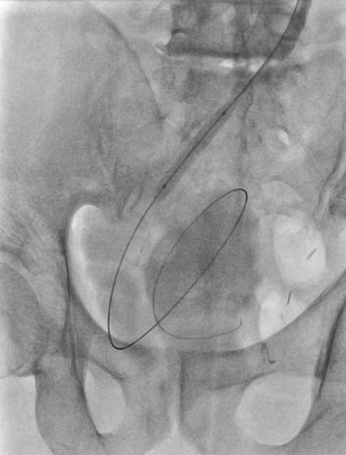 비뇨기계 중재 시술 (Urinary Intervention)
