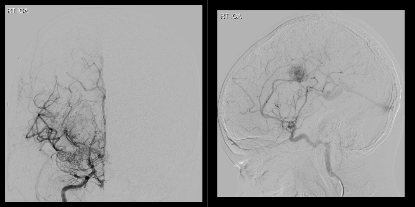 혈관조영술 (Angiography)