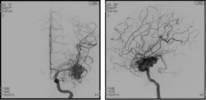 뇌혈관 조영술(Transfemoral cerebral angiography; TFCA)