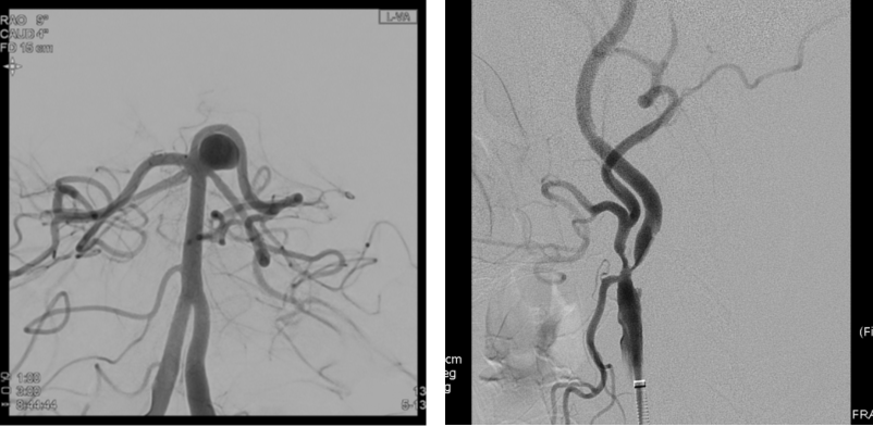 뇌혈관 조영술(Transfemoral cerebral angiography; TFCA)