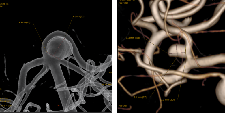 뇌혈관 조영술(Transfemoral cerebral angiography; TFCA)