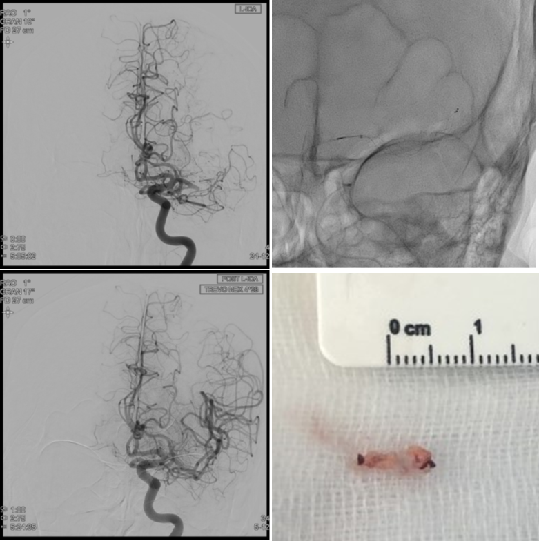 뇌동맥 혈전제거술 (Intra-arterial thrombectomy)