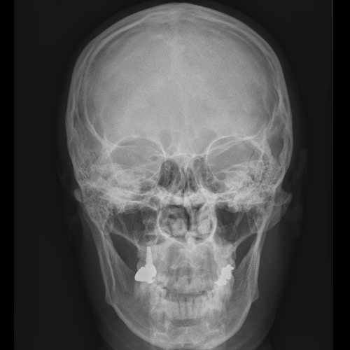 일반 X선 촬영 (Plain Radiography)