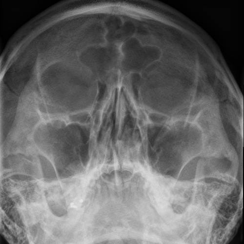 일반 X선 촬영 (Plain Radiography)