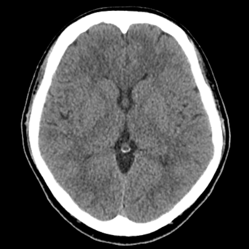 전산화단층촬영 (Computed Tomography: CT)